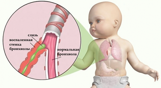 Бронхит у детей Бронхит у детей