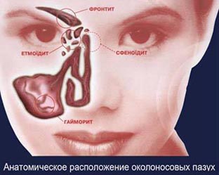Лечение гайморита Лечение гайморита