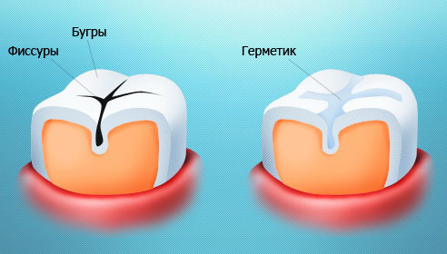 Герметизация фиссур Герметизация фиссур