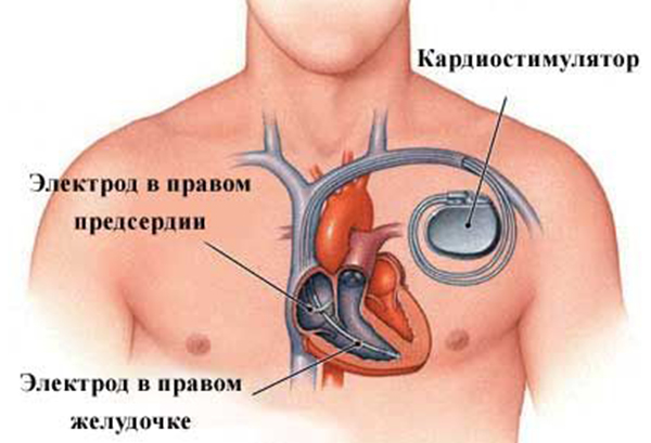 В кардиодиспансере Рязани увеличивается количество операций по установке электрокардиостимуляторов