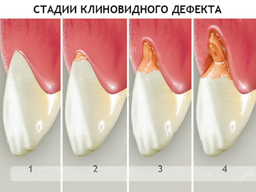Клиновидный дефект Клиновидный дефект