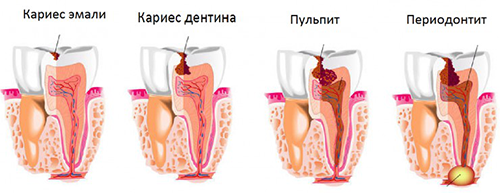 Периодонтит Периодонтит