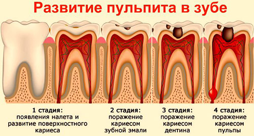 Пульпит Пульпит